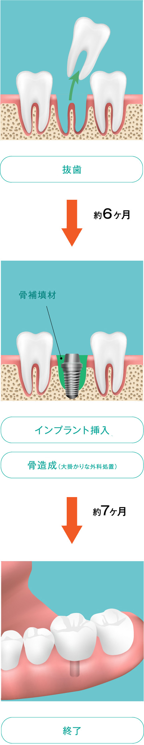 通常のインプラント手術の必要時間|いしはた歯科クリニック