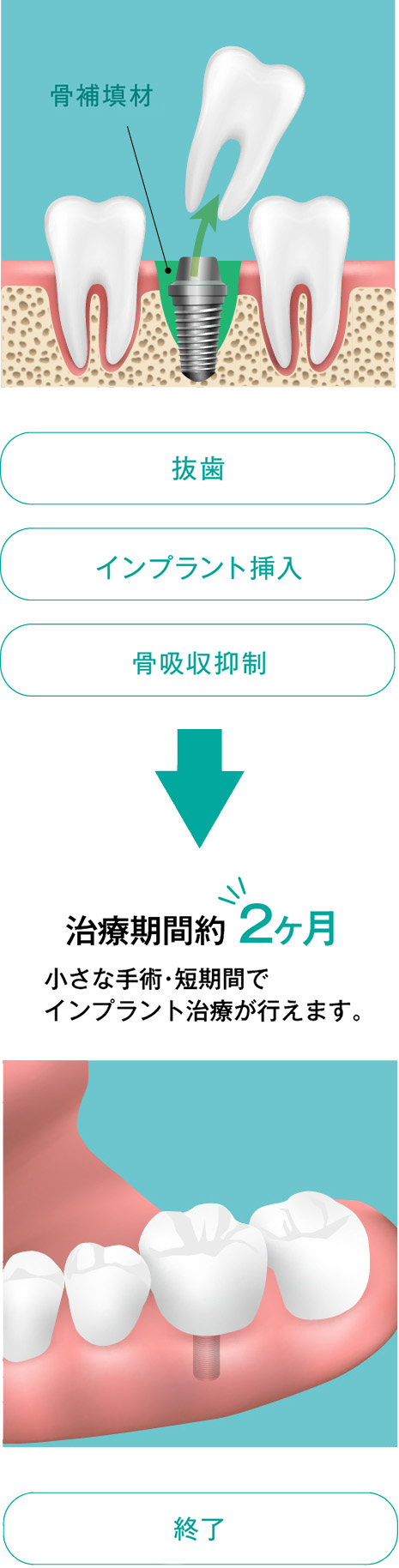 即時荷重インプラントの場合は経過時間が少なく手術ができます|いしはた歯科クリニック